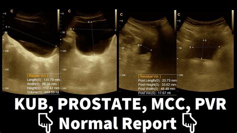 kub ultrasound normal results|Abdomen (KUB view) .